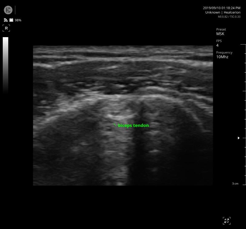 SONON 300L ecografía 1