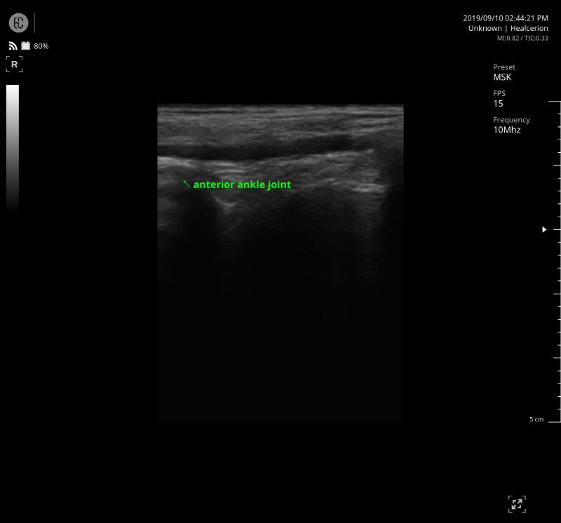 SONON 300L ecografía 3